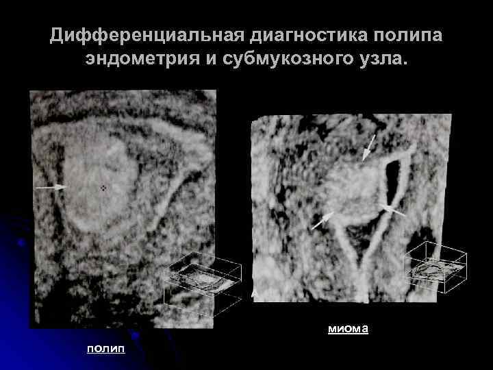 Дифференциальная диагностика полипа эндометрия и субмукозного узла. миома полип 