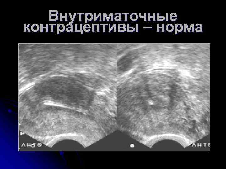Внутриматочные контрацептивы – норма 