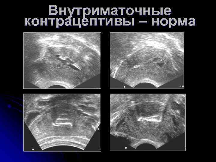 Внутриматочные контрацептивы – норма 
