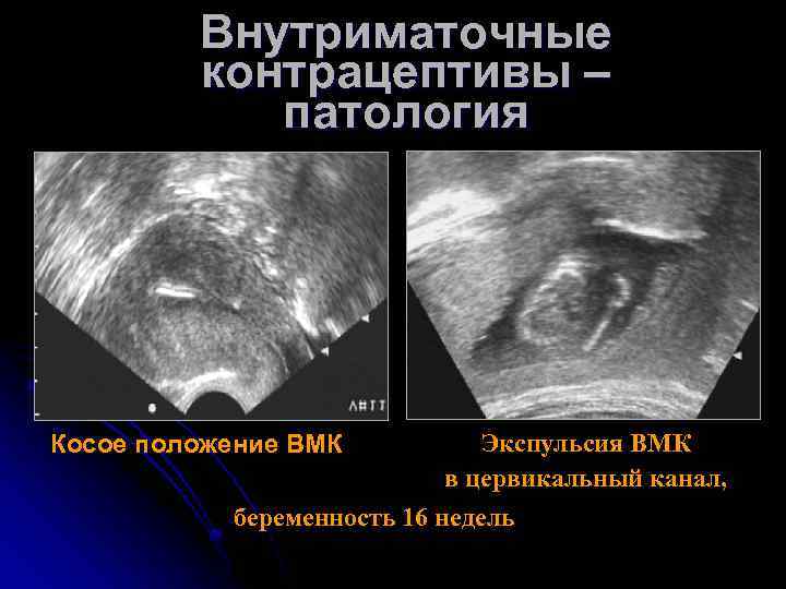 Внутриматочные контрацептивы – патология Косое положение ВМК Экспульсия ВМК в цервикальный канал, беременность 16