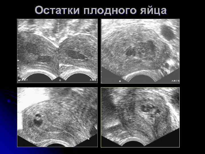 Остатки плодного яйца 