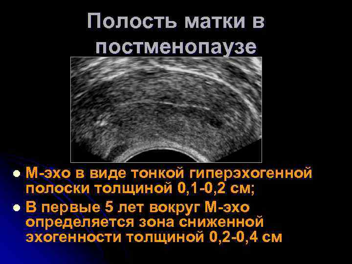 Размер полости матки. Эндометрия матки УЗИ гиперплазия эндометрия. Эхогенность эндометрия. Эндометрия в постменопаузе по УЗИ. Эндометрий в менопаузе на УЗИ.