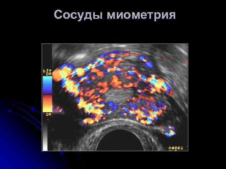 Локальное утолщение миометрия по передней стенке