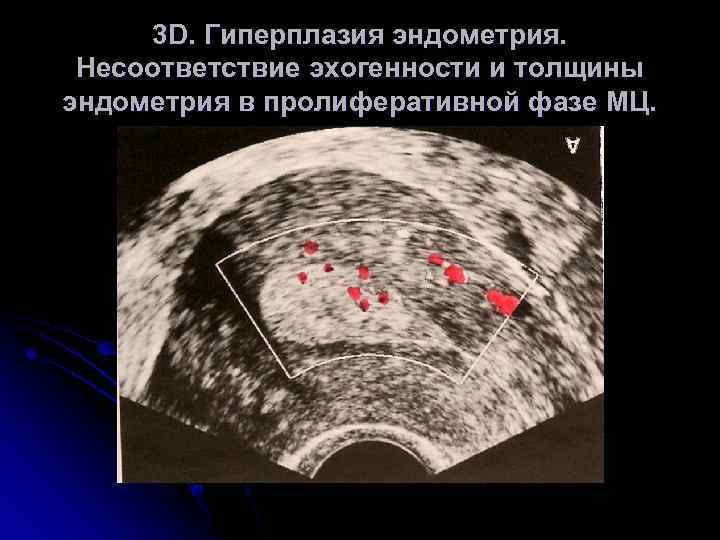 Гиперплазия матки в менопаузе чем опасно. Атипическая гиперплазия эндометрия УЗИ. Гиперплазия эндометрия МФЯ. Пролиферативная фаза эндометрия. Железистая гиперплазия эндометрия УЗИ.