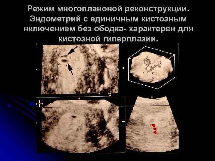 Цитологическая картина зоба с кистозной дегенерацией