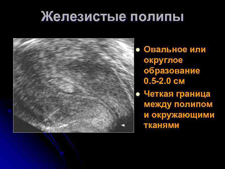 Железистые полипы l l Овальное или округлое образование 0. 5 -2. 0 см Четкая
