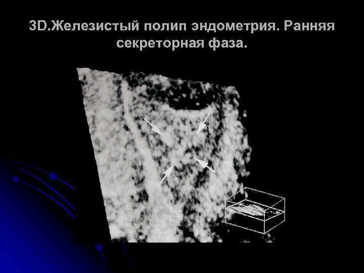 3 D. Железистый полип эндометрия. Ранняя секреторная фаза. 