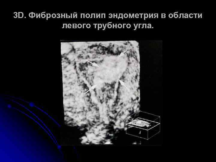 3 D. Фиброзный полип эндометрия в области левого трубного угла. 