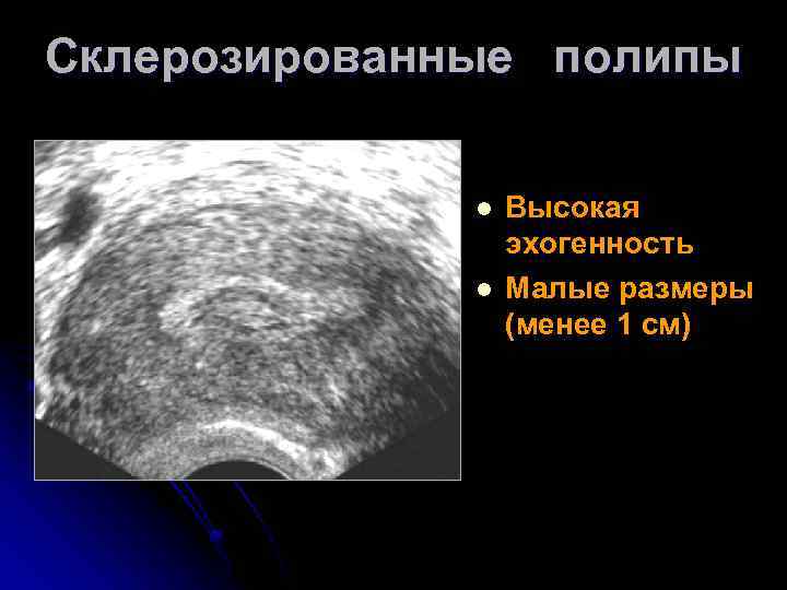 Склерозированные полипы l l Высокая эхогенность Малые размеры (менее 1 см) 