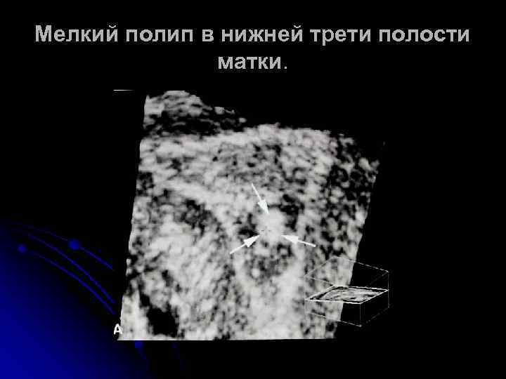 Мелкий полип в нижней трети полости матки. 