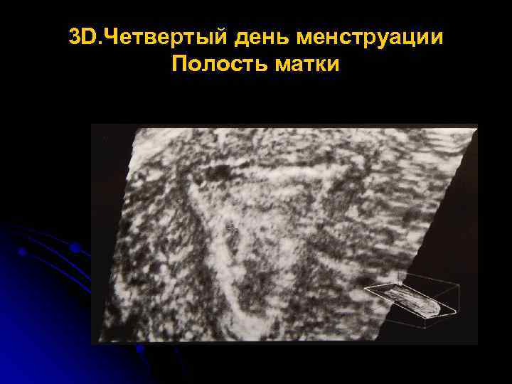 3 D. Четвертый день менструации Полость матки 