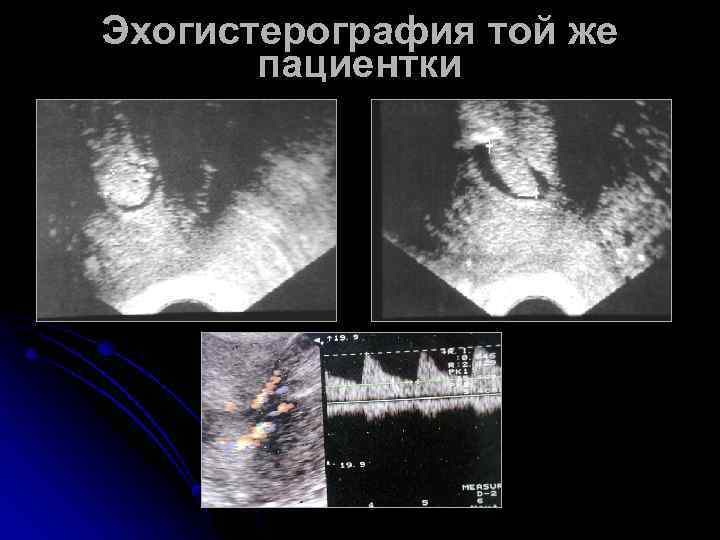 Эхогистерография той же пациентки 