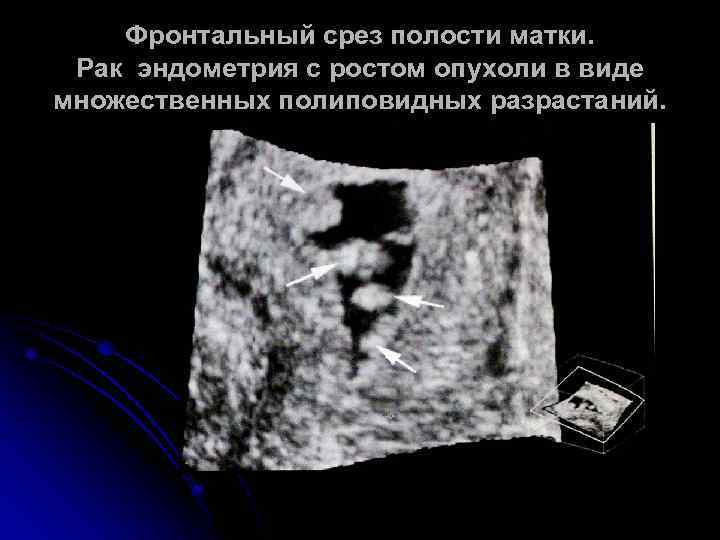 Фронтальный срез полости матки. Рак эндометрия с ростом опухоли в виде множественных полиповидных разрастаний.