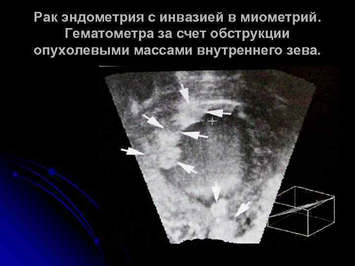 Рак эндометрия с инвазией в миометрий. Гематометра за счет обструкции опухолевыми массами внутреннего зева.