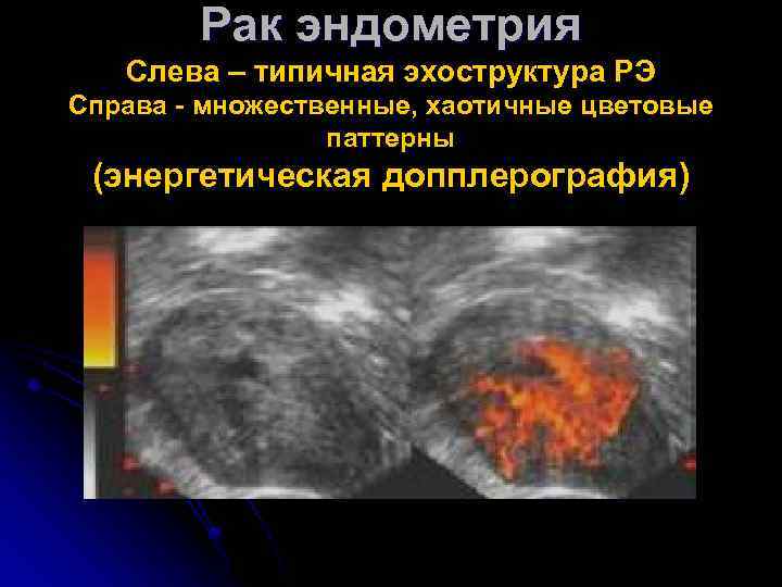 Рак эндометрия Слева – типичная эхоструктура РЭ Справа - множественные, хаотичные цветовые паттерны (энергетическая