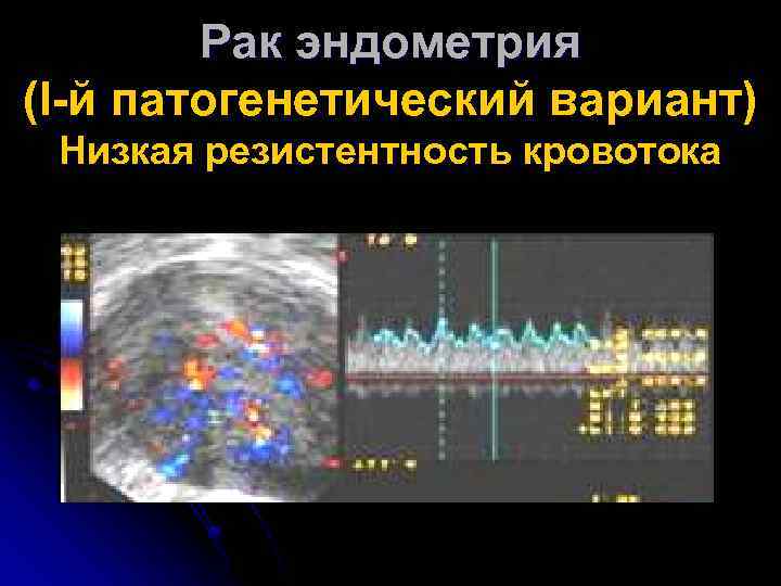 Рак эндометрия (I-й патогенетический вариант) Низкая резистентность кровотока 