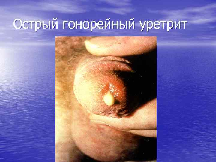 Острый гонорейный уретрит 