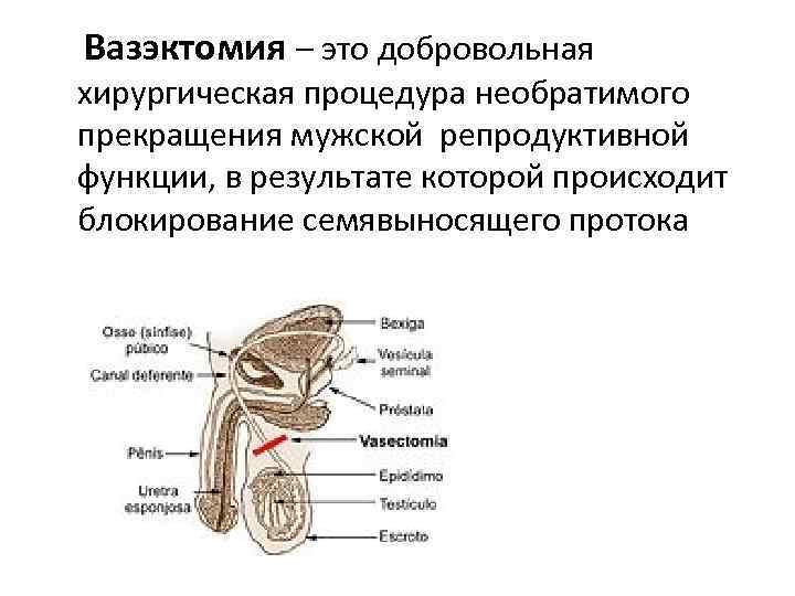 Вазэктомия – это добровольная хирургическая процедура необратимого прекращения мужской репродуктивной функции, в результате которой