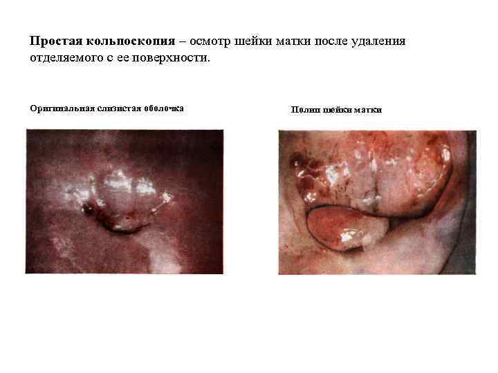 Простая кольпоскопия – осмотр шейки матки после удаления отделяемого с ее поверхности. Оригинальная слизистая