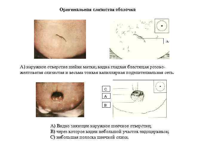 Оригинальная слизистая оболочка А) наружное отверстие шейки матки; видна гладкая блестящая розовожелтоватая слизистая и