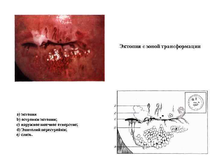 Эктопия с зоной трансформации а) эктопия b) островки эктопии; с) наружное шеечное отверстие; d)