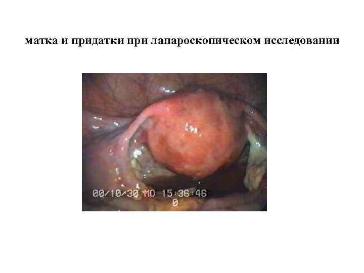 матка и придатки при лапароскопическом исследовании 