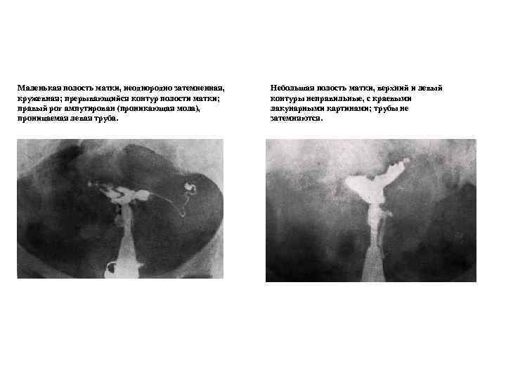 Маленькая полость матки, неоднородно затемненная, кружевная; прерывающийся контур полости матки; правый рог ампутирован (проникающая