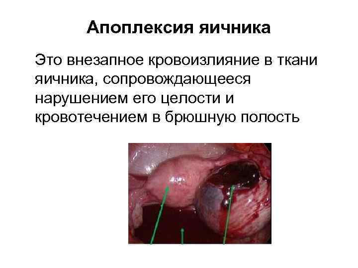 Апоплексия яичника Это внезапное кровоизлияние в ткани яичника, сопровождающееся нарушением его целости и кровотечением