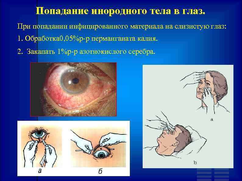 Попадание инородного тела в глаз. При попадании инфицированного материала на слизистую глаз: 1. Обработка
