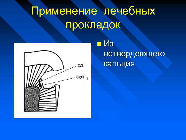 Лечебные прокладки в стоматологии. Твердеющие и нетвердеющие лечебные прокладки. Применение лечебной прокладки. Пластичные нетвердеющие материалы представители. Недостатки пластичных нетвердеющих материалов.