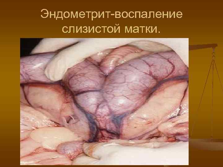 Эндометрит-воспаление слизистой матки. 