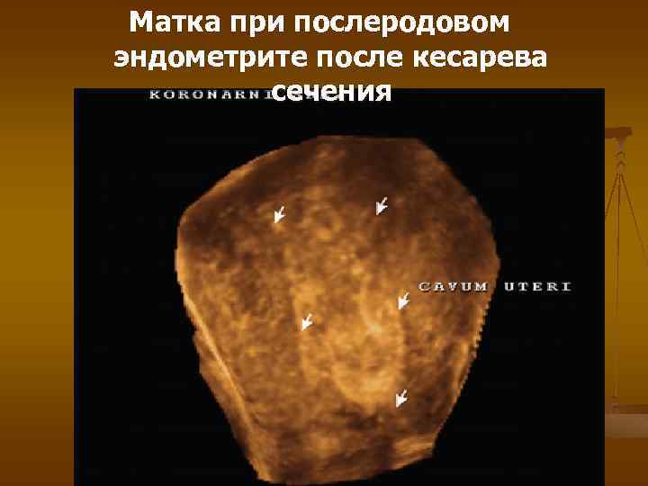 Матка при послеродовом эндометрите после кесарева сечения 