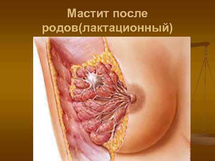 Мастит после родов(лактационный) 