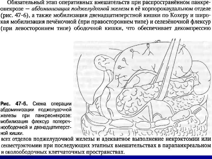 Абдоминизация поджелудочной железы