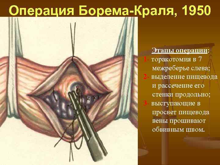 Операция Борема-Краля, 1950 Этапы операции: 1 торакотомия в 7 межреберье слева; 2 выделение пищевода