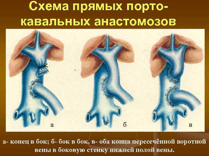 Кавакавальные анастомозы и портокавальные схема