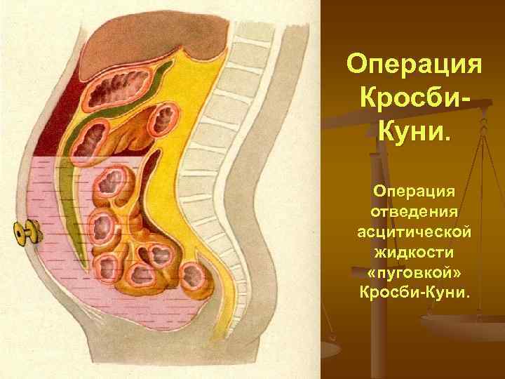 Операция Кросби. Куни. Операция отведения асцитической жидкости «пуговкой» Кросби-Куни. 