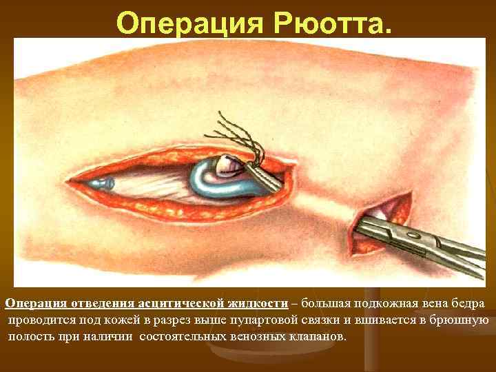 Операция Рюотта. Операция отведения асцитической жидкости – большая подкожная вена бедра проводится под кожей