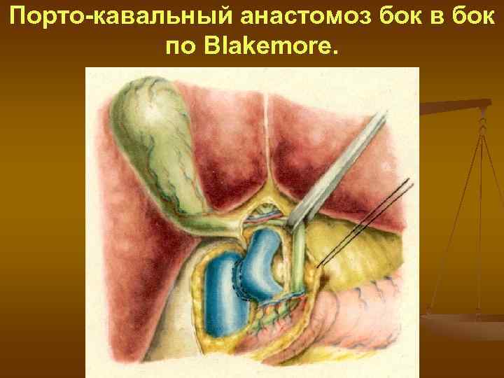 Порто-кавальный анастомоз бок в бок по Blakemore. 