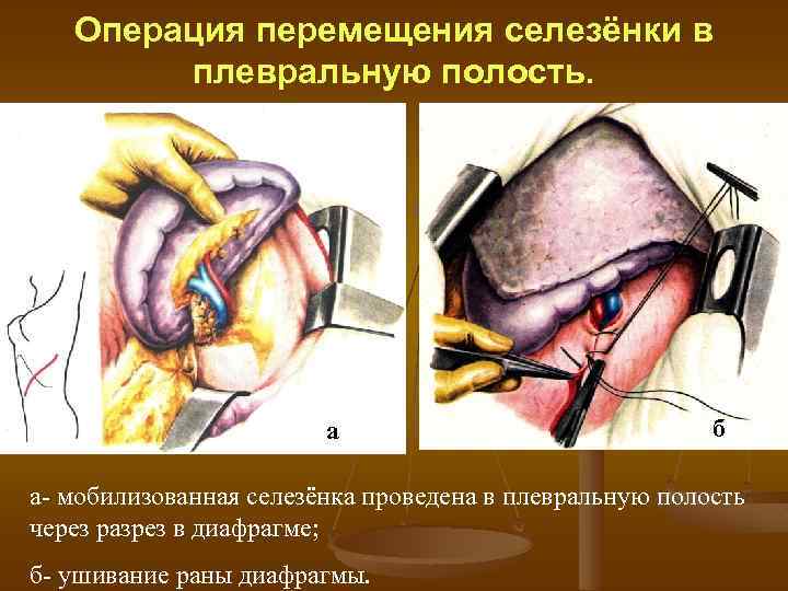 Операция перемещения селезёнки в плевральную полость. а б а- мобилизованная селезёнка проведена в плевральную