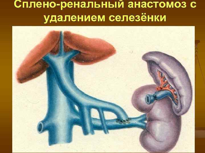 Сплено-ренальный анастомоз с удалением селезёнки 