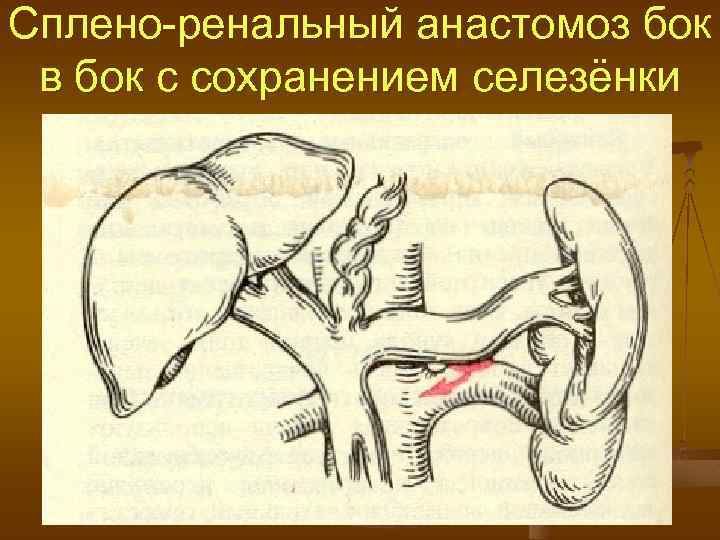 Сплено-ренальный анастомоз бок в бок с сохранением селезёнки 