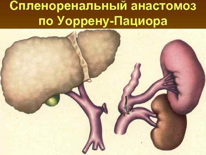 Спленоренальный анастомоз по Уоррену-Пациора 