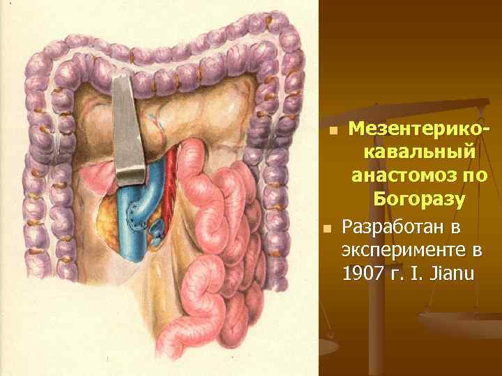 n n Мезентерикокавальный анастомоз по Богоразу Разработан в эксперименте в 1907 г. I. Jianu