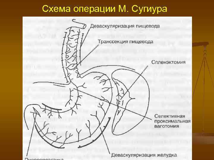 Схема операции М. Сугиура 