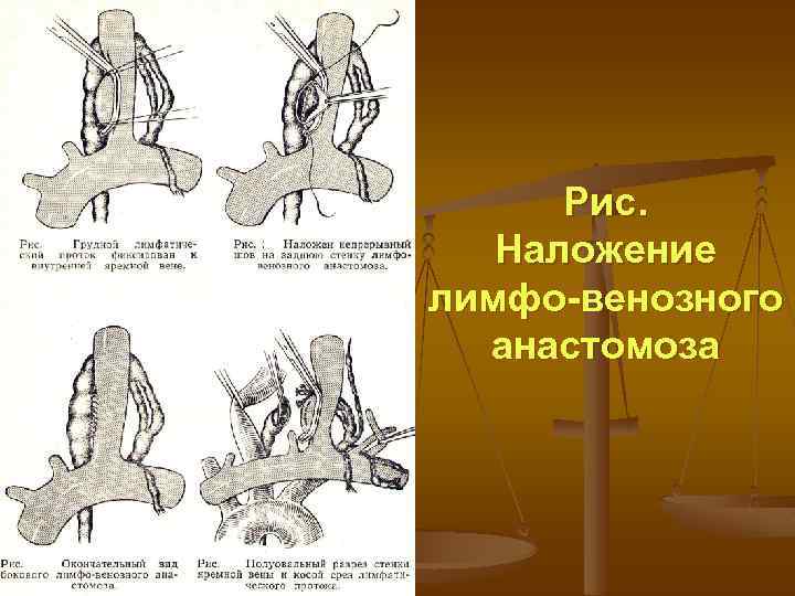 Рис. Наложение лимфо-венозного анастомоза 