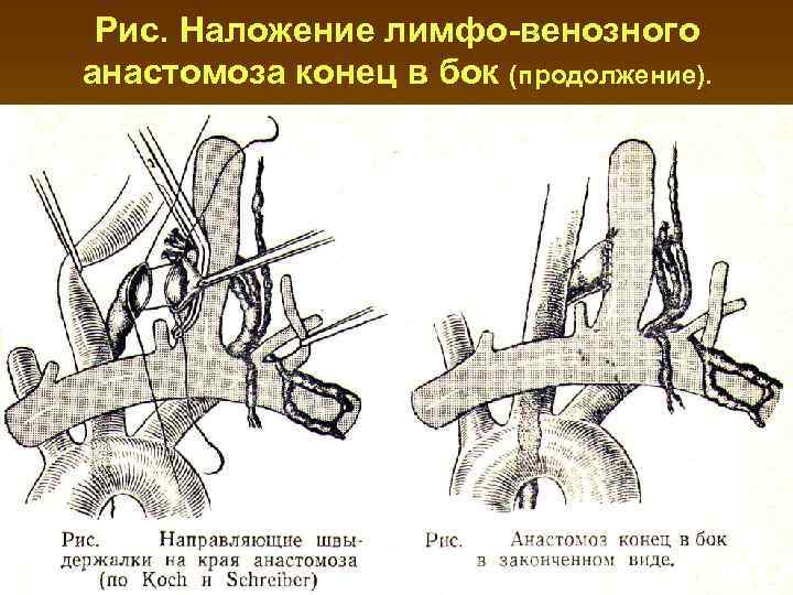 Анастомоз конец в конец схема