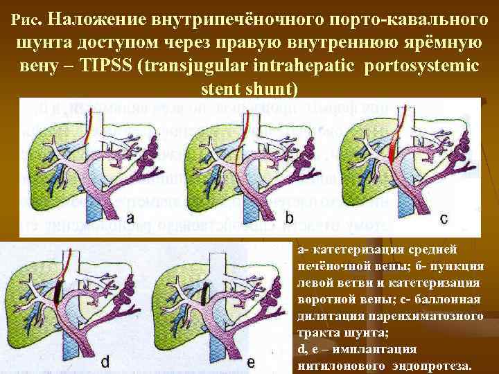 Рис. Наложение внутрипечёночного порто кавального шунта доступом через правую внутреннюю ярёмную вену – TIPSS