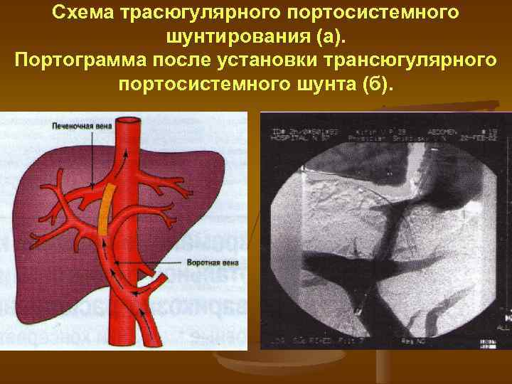 Схема трасюгулярного портосистемного шунтирования (а). Портограмма после установки трансюгулярного портосистемного шунта (б). 