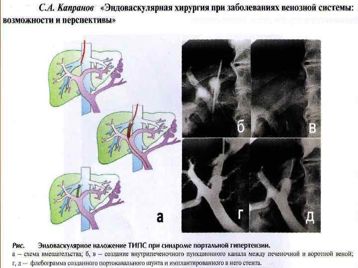 Портальная гипертензия хирургия презентация